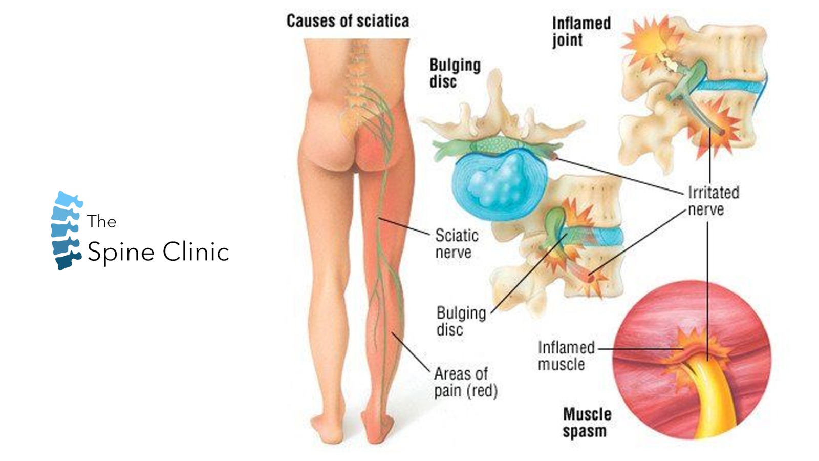 Sciatica Treatment The Spine Clinics