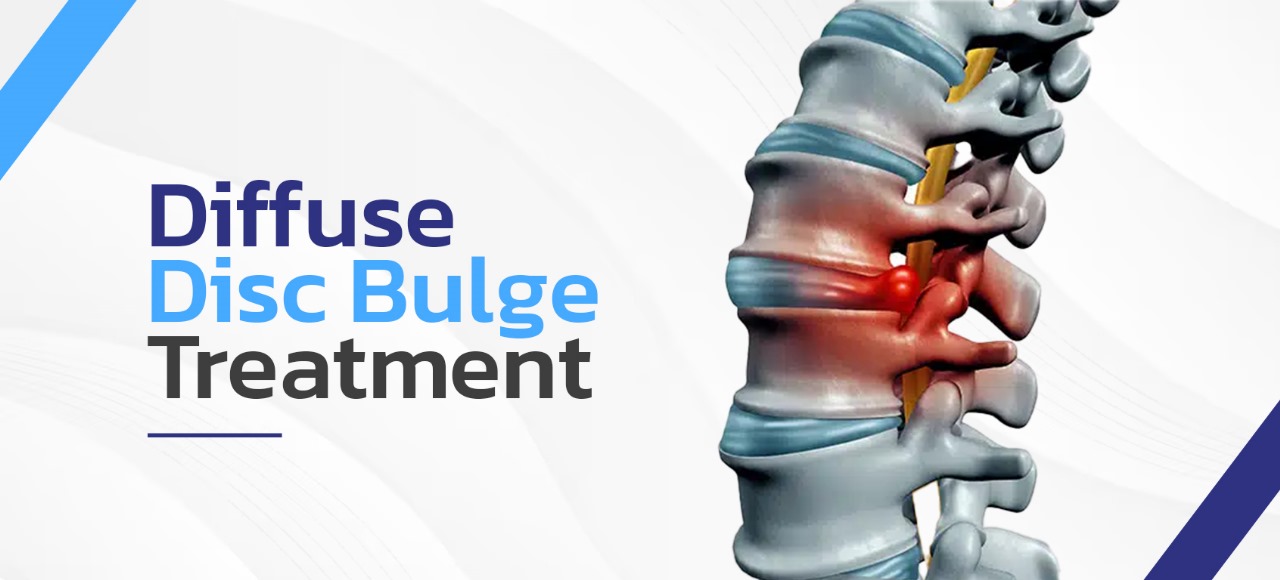 Diffuse Disc Bulge Treatment | The Spine Clinic