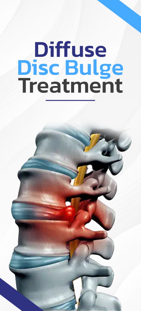 Diffuse Disc Bulge Treatments