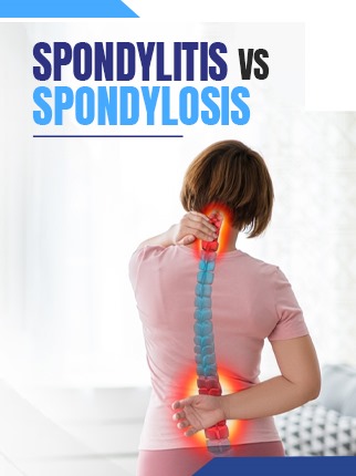 Spondylosis Vs Spondylitis
